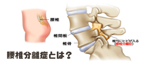 腰痛ベルト セール 椎骨分離