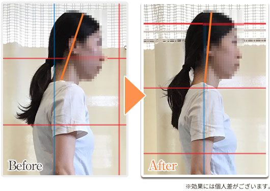 ストレートネックビフォーアフター