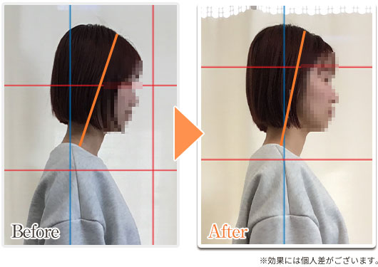 ストレートネックビフォーアフター